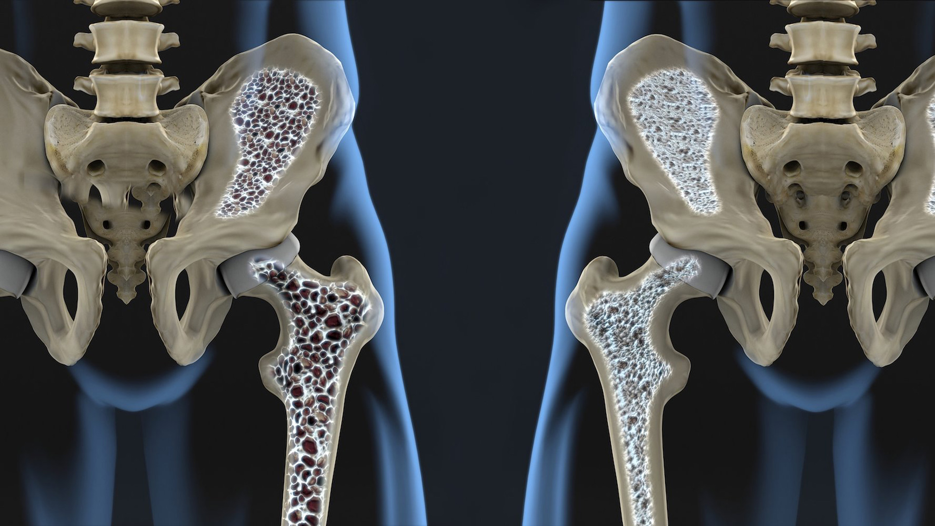 Sonuç: Osteoporoz (Kemik Erimesi) Nedir, Belirtileri, Tanı ve Tedavisi Nelerdir?