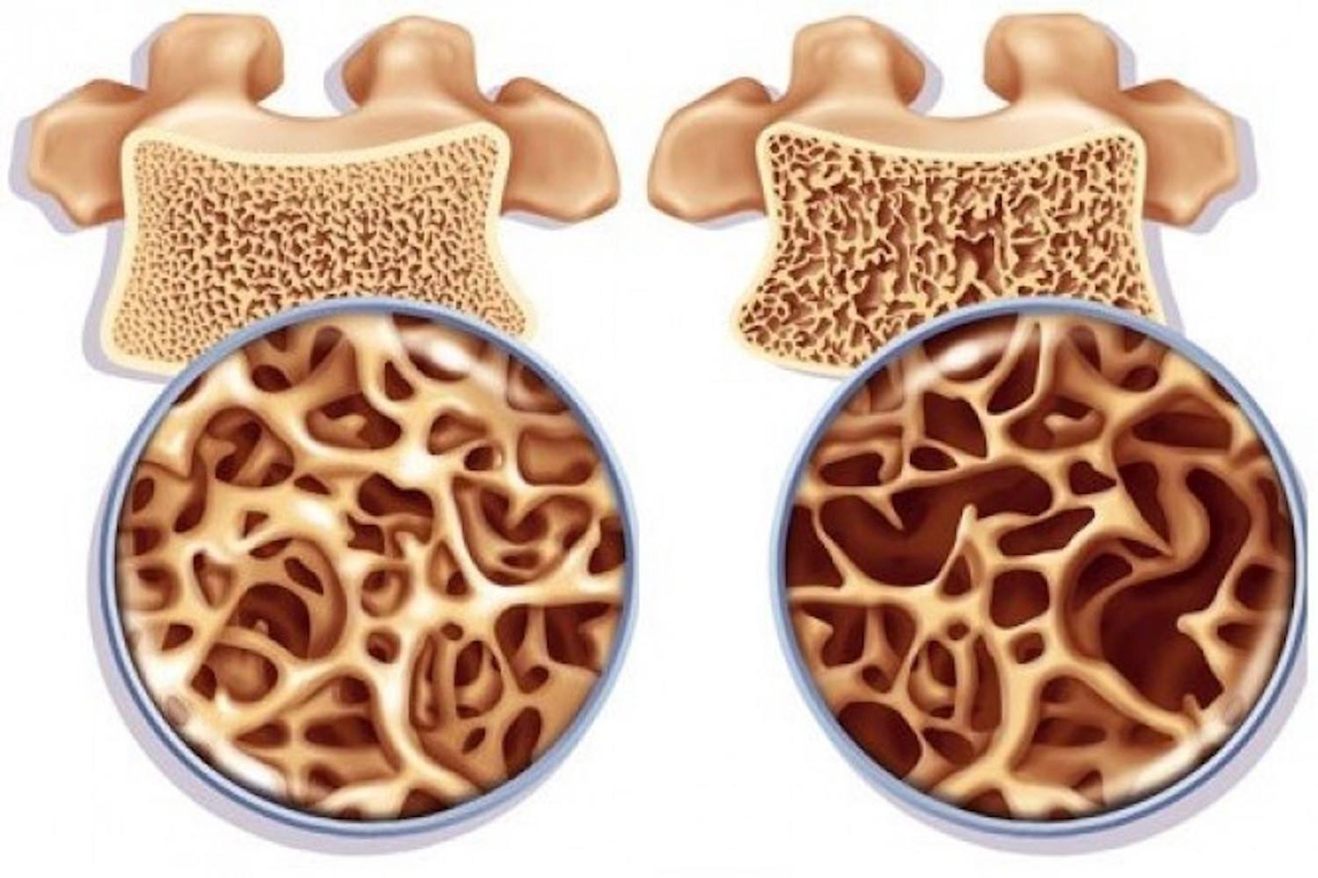 Osteoporoz kimlerde görülür?